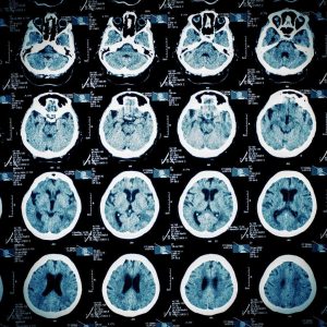 Brain Injury scans