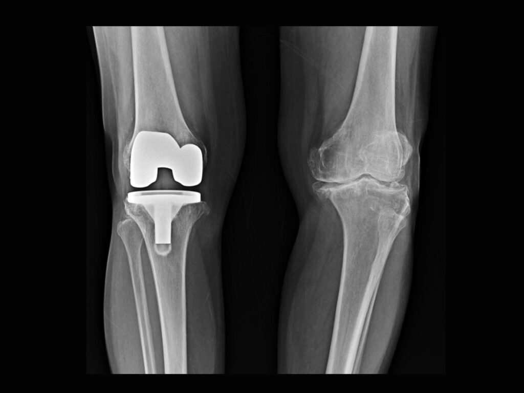 Film X-ray of a knee replacement implant
