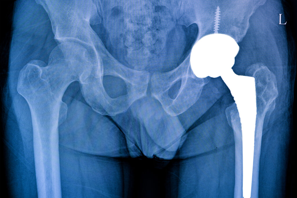X-ray film of a patient with total left hip operation .