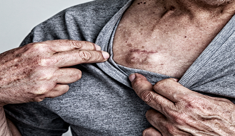 Am I Eligible for a Philips CPAP Lawsuit?